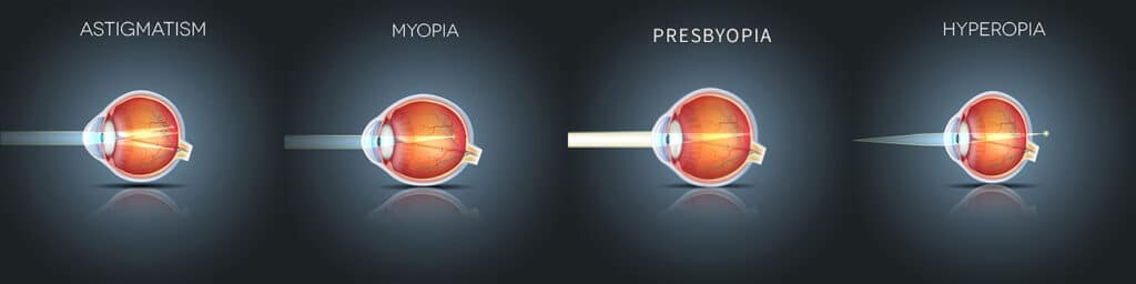 Chart illustrating how light affects an eye with different conditions