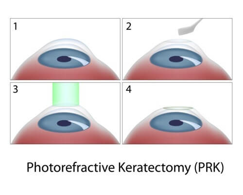 Chart illustrating the prk surgery process