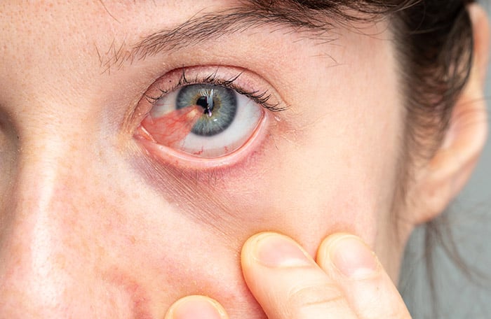 Person with a Pterygium in their eye